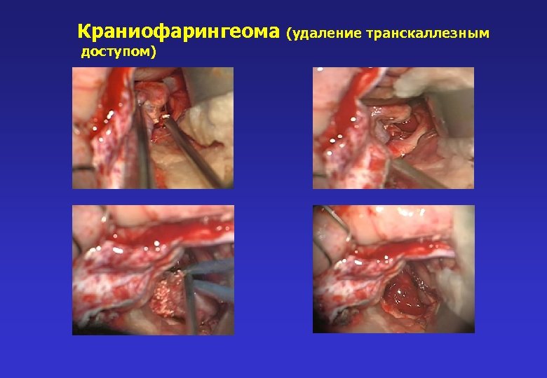 Краниофарингеома (удаление транскаллезным доступом) 