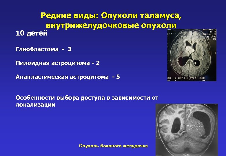 Редкие виды: Опухоли таламуса, внутрижелудочковые опухоли 10 детей Глиобластома - 3 Пилоидная астроцитома -