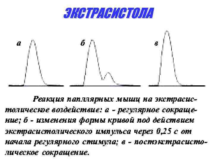 ЭКСТРАСИСТОЛА 