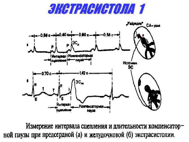 ЭКСТРАСИСТОЛА 1 