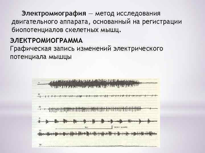 Электромиография — метод исследования двигательного аппарата, основанный на регистрации биопотенциалов скелетных мышц. ЭЛЕКТРОМИОГРАММА Графическая