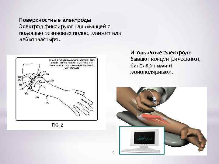 Поверхностные электроды Электрод фиксируют над мышцей с помощью резиновых полос, манжет или лейкопластыря. Игольчатые