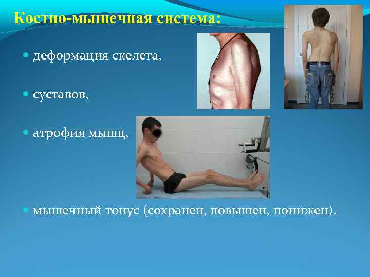 Костно-мышечная система: деформация скелета, суставов, атрофия мышц, мышечный тонус (сохранен, повышен, понижен). 
