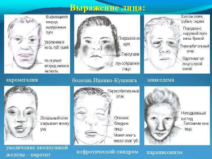 Выражение лица: акромегалия увеличение околоушной железы – паротит болезнь Иценко-Кушинга нефротический синдром микседема паркинсонизм