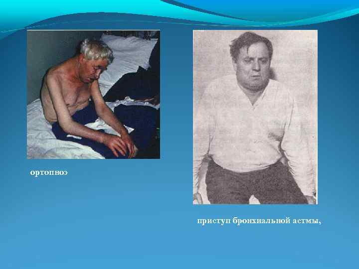ортопноэ приступ бронхиальной астмы, 