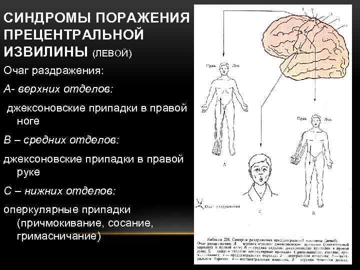 СИНДРОМЫ ПОРАЖЕНИЯ ПРЕЦЕНТРАЛЬНОЙ ИЗВИЛИНЫ (ЛЕВОЙ) Очаг раздражения: А- верхних отделов: джексоновские припадки в правой