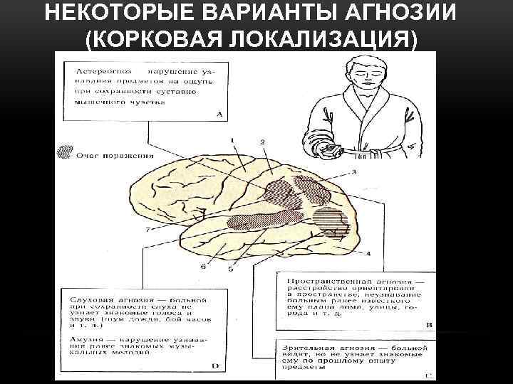 НЕКОТОРЫЕ ВАРИАНТЫ АГНОЗИИ (КОРКОВАЯ ЛОКАЛИЗАЦИЯ) 
