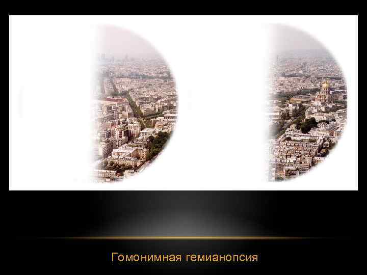 Гомонимная гемианопсия 