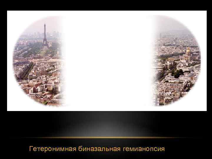 Гетеронимная биназальная гемианопсия 