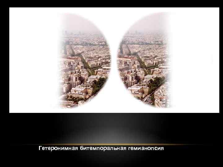 Гетеронимная битемпоральная гемианопсия 