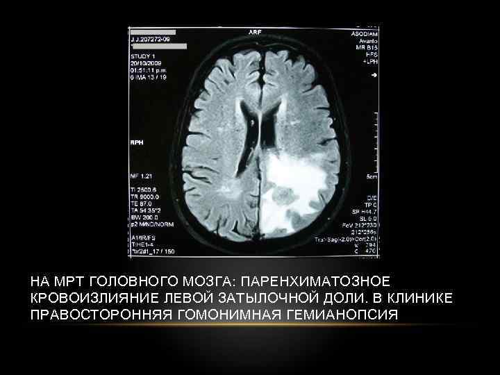НА МРТ ГОЛОВНОГО МОЗГА: ПАРЕНХИМАТОЗНОЕ КРОВОИЗЛИЯНИЕ ЛЕВОЙ ЗАТЫЛОЧНОЙ ДОЛИ. В КЛИНИКЕ ПРАВОСТОРОННЯЯ ГОМОНИМНАЯ ГЕМИАНОПСИЯ