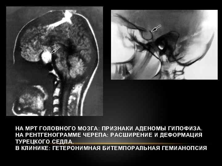 НА МРТ ГОЛОВНОГО МОЗГА: ПРИЗНАКИ АДЕНОМЫ ГИПОФИЗА. НА РЕНТГЕНОГРАММЕ ЧЕРЕПА: РАСШИРЕНИЕ И ДЕФОРМАЦИЯ ТУРЕЦКОГО