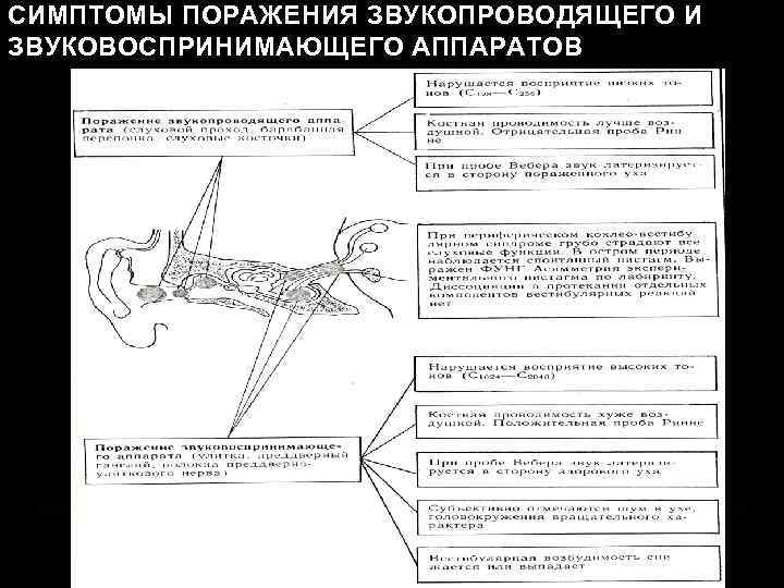 СИМПТОМЫ ПОРАЖЕНИЯ ЗВУКОПРОВОДЯЩЕГО И ЗВУКОВОСПРИНИМАЮЩЕГО АППАРАТОВ 
