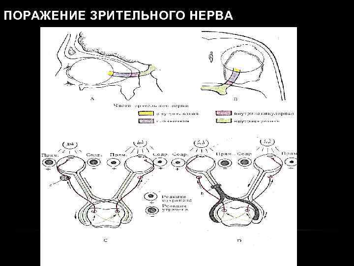 ПОРАЖЕНИЕ ЗРИТЕЛЬНОГО НЕРВА 