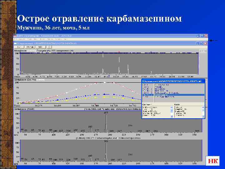 Острое отравление карбамазепином Мужчина, 36 лет, моча, 5 мл НК 