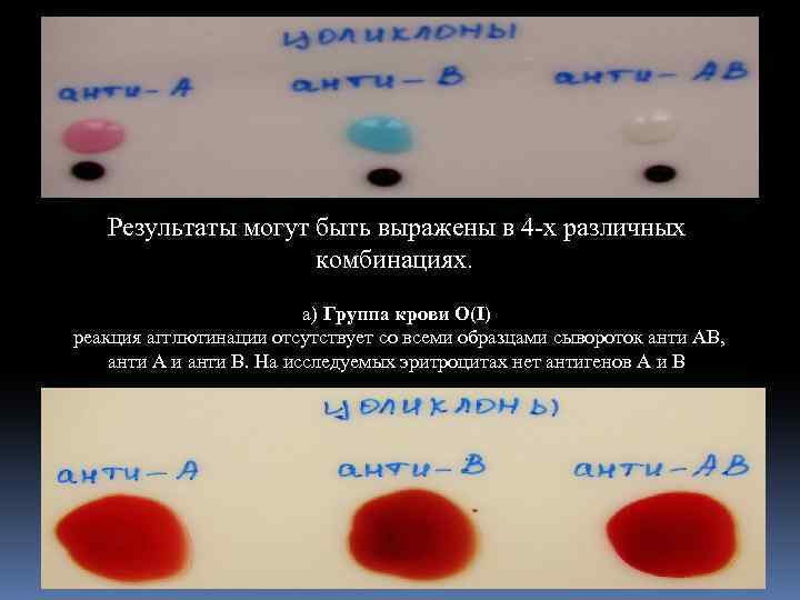 Результаты могут быть выражены в 4 -х различных комбинациях. а) Группа крови О(I) реакция