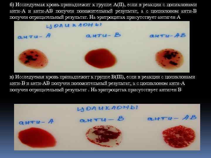 б) Исследуемая кровь принадлежит к группе А(II), если в реакции с цоликлонами анти-АВ получен