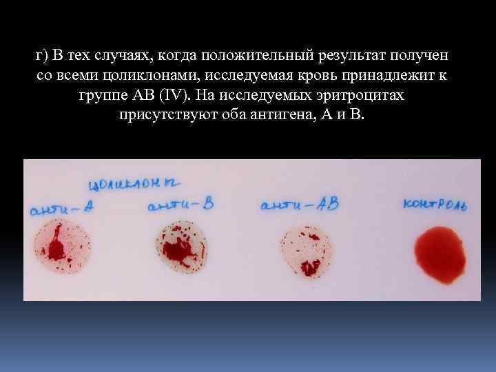 г) В тех случаях, когда положительный результат получен со всеми цоликлонами, исследуемая кровь принадлежит