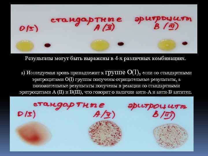 Результаты могут быть выражены в 4 -х различных комбинациях. а) Исследуемая кровь принадлежит к