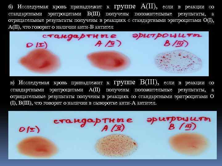 б) Исследуемая кровь принадлежит к группе А(II), если в реакции со стандартными эритроцитами B(III)