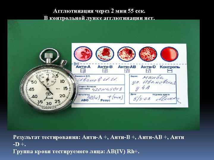 Агглютинация через 2 мин 55 сек. В контрольной лунке агглютинации нет. Результат тестирования: Анти-А