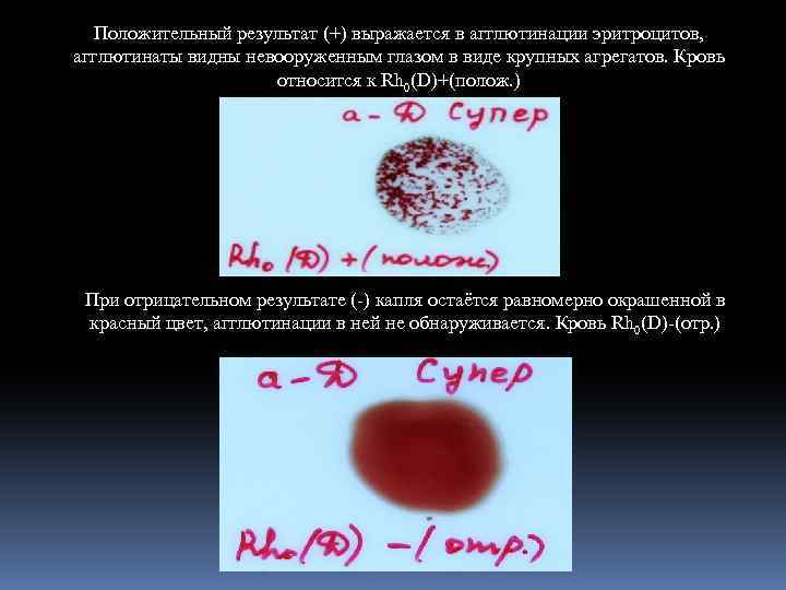 Положительный результат (+) выражается в агглютинации эритроцитов, агглютинаты видны невооруженным глазом в виде крупных