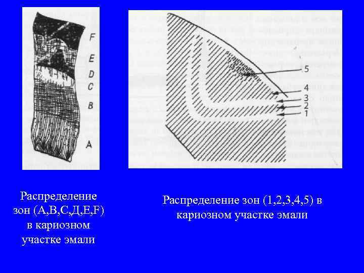 Распределение зон (А, В, С, Д, Е, F) в кариозном участке эмали Распределение зон