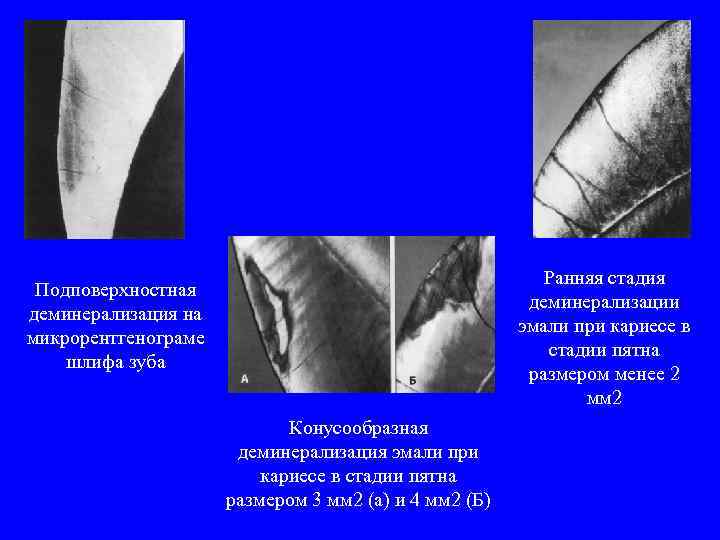 Ранняя стадия деминерализации эмали при кариесе в стадии пятна размером менее 2 мм 2