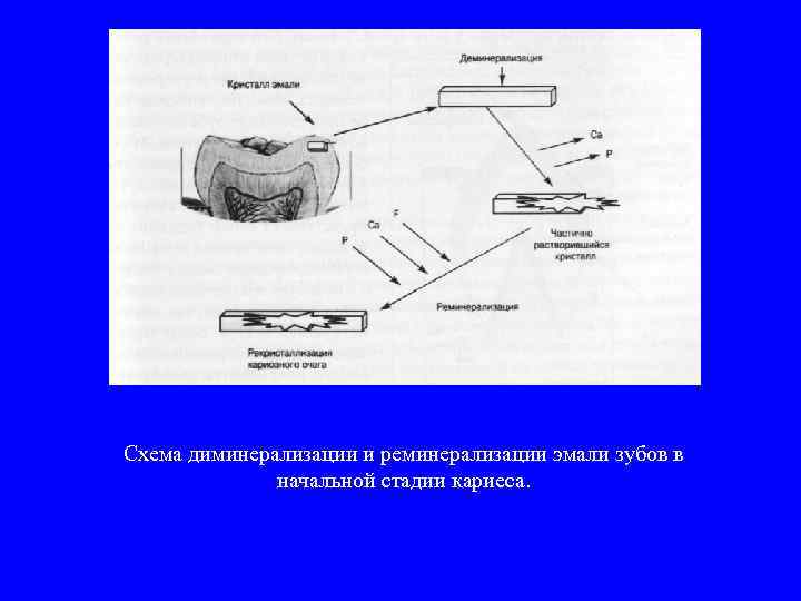 Схема диминерализации и реминерализации эмали зубов в начальной стадии кариеса. 