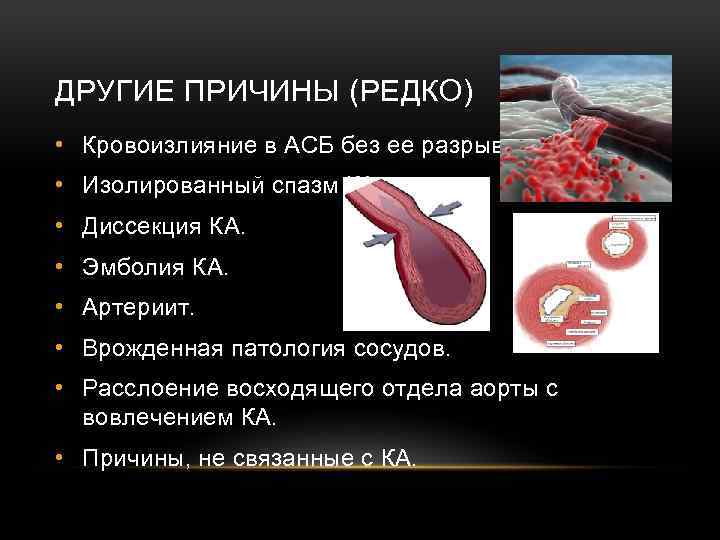 ДРУГИЕ ПРИЧИНЫ (РЕДКО) • Кровоизлияние в АСБ без ее разрыва. • Изолированный спазм КА.