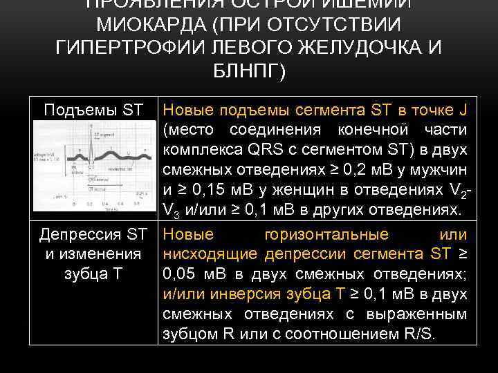 ПРОЯВЛЕНИЯ ОСТРОЙ ИШЕМИИ МИОКАРДА (ПРИ ОТСУТСТВИИ ГИПЕРТРОФИИ ЛЕВОГО ЖЕЛУДОЧКА И БЛНПГ) Подъемы ST Новые