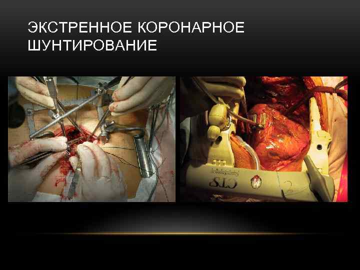 ЭКСТРЕННОЕ КОРОНАРНОЕ ШУНТИРОВАНИЕ 