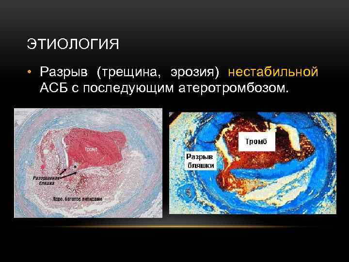 ЭТИОЛОГИЯ • Разрыв (трещина, эрозия) нестабильной АСБ с последующим атеротромбозом. 