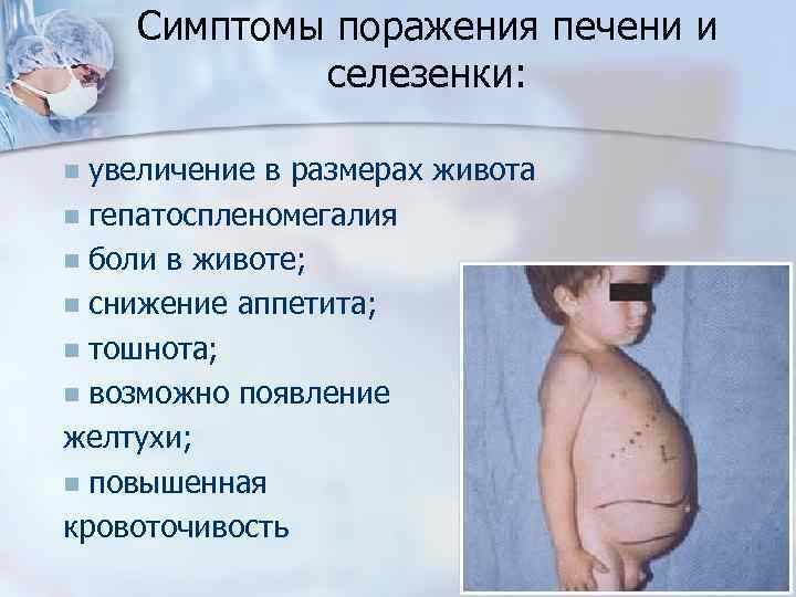 Симптомы поражения печени и селезенки: увеличение в размерах живота n гепатоспленомегалия n боли в