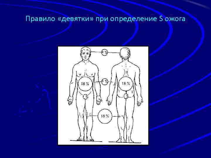 Правило «девятки» при определение S ожога 