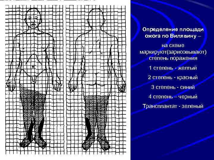 Определение площади ожога по Вилявину – на схеме маркируют(зарисовывают) степень поражения 1 степень -