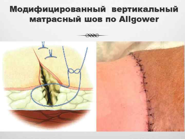 Модифицированный вертикальный матрасный шов по Allgower 