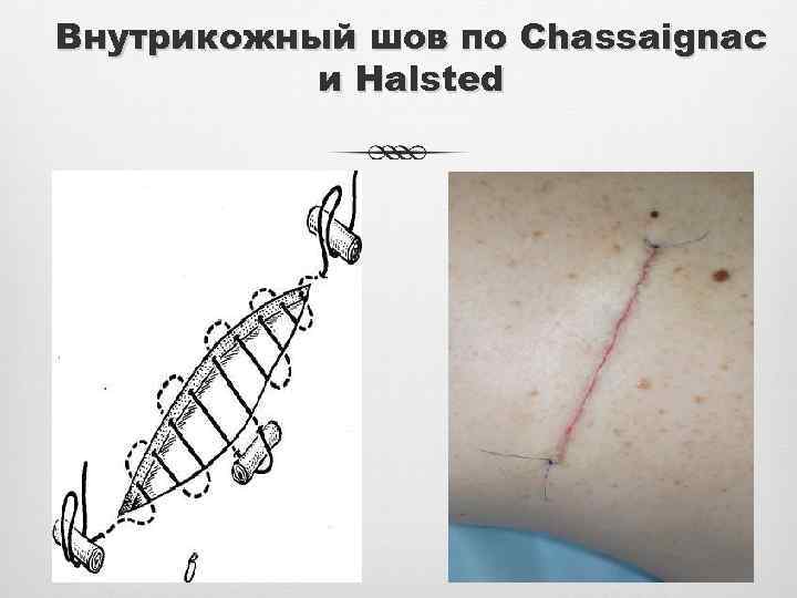 Внутрикожный шов по Chassaignac и Halsted 