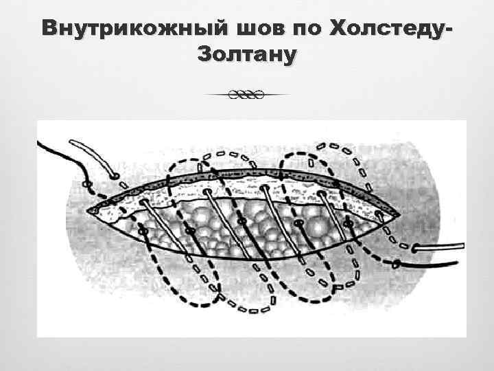 Внутрикожный шов по Холстеду. Золтану 