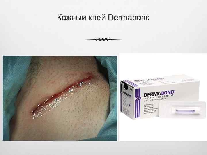 Кожный клей Dermabond 