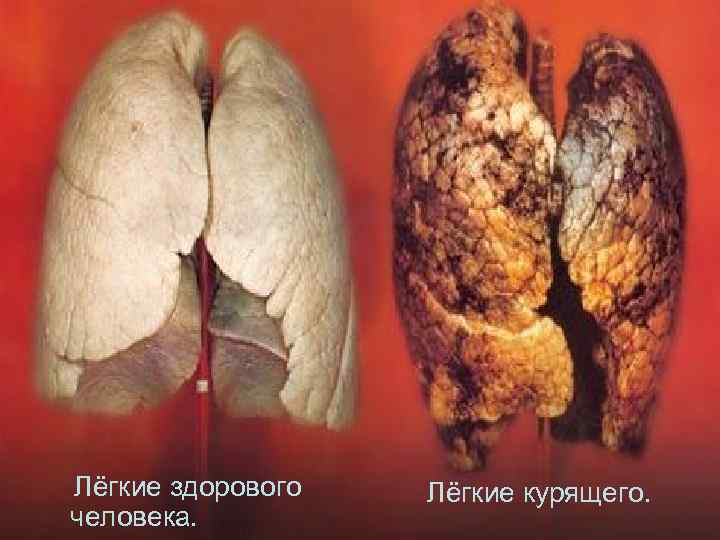 Лёгкие здорового человека. Лёгкие курящего. 