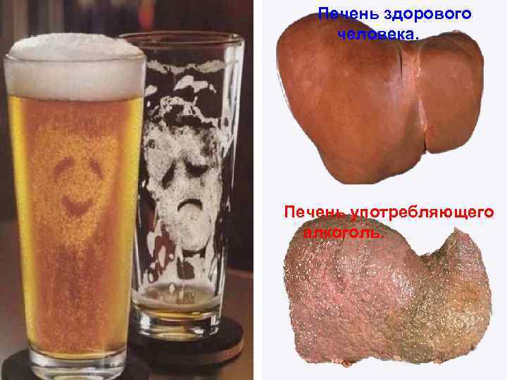 Печень здорового человека. Печень употребляющего алкоголь. 