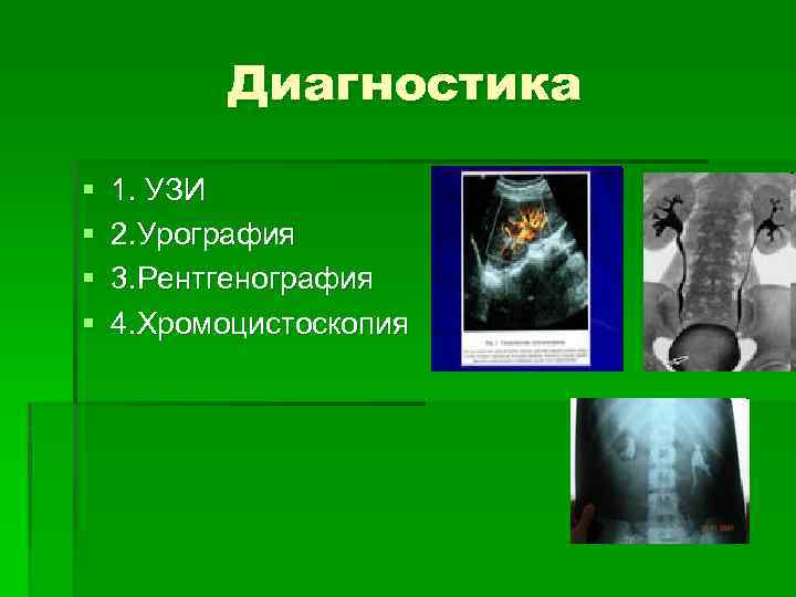 Диагностика § § 1. УЗИ 2. Урография 3. Рентгенография 4. Хромоцистоскопия 