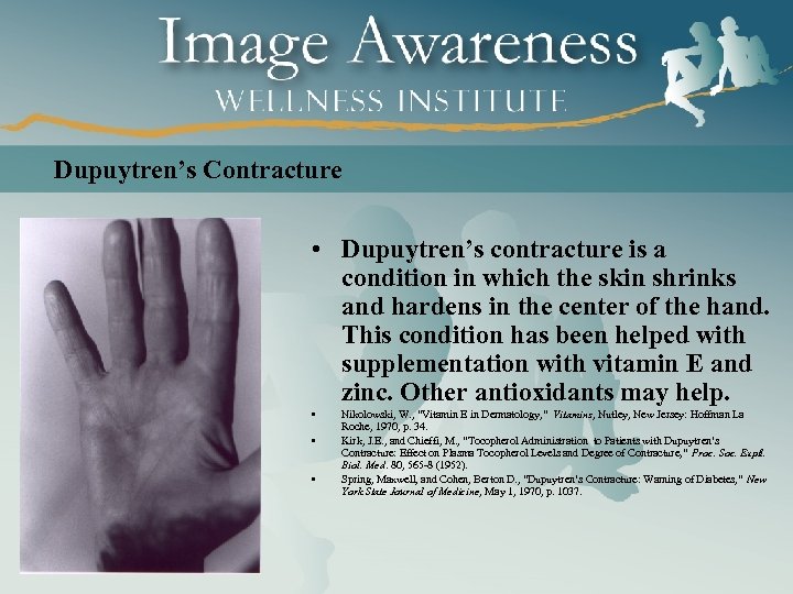 Dupuytren’s Contracture • Dupuytren’s contracture is a condition in which the skin shrinks and