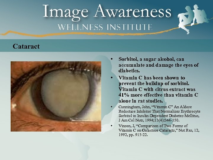 Cataract • • Sorbitol, a sugar alcohol, can accumulate and damage the eyes of