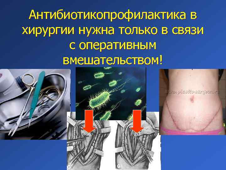 Антибиотикопрофилактика в хирургии нужна только в связи с оперативным вмешательством! 