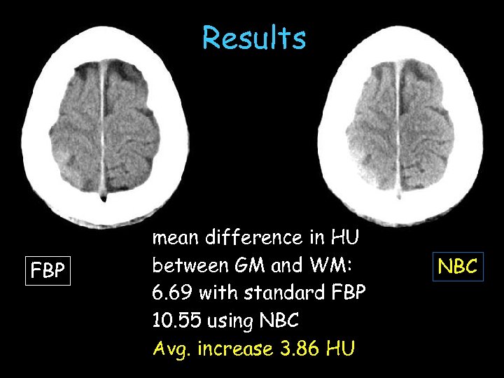 Results FBP mean difference in HU between GM and WM: 6. 69 with standard