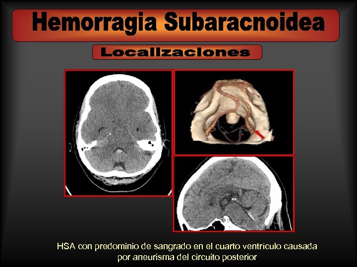 HSA con predominio de sangrado en el cuarto ventrículo causada por aneurisma del circuito