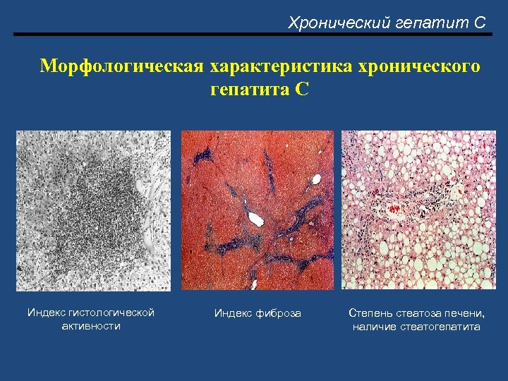 Хронический гепатит С Морфологическая характеристика хронического гепатита С Индекс гистологической активности Индекс фиброза Степень