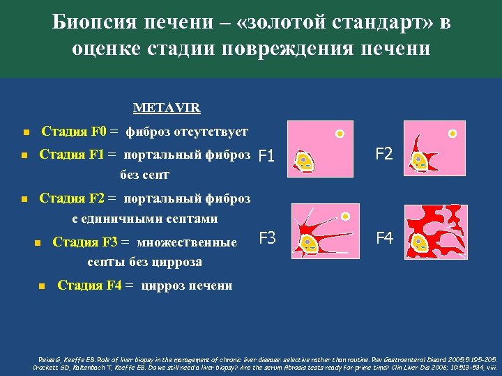 Биопсия печени – «золотой стандарт» в оценке стадии повреждения печени METAVIR Стадия F 0